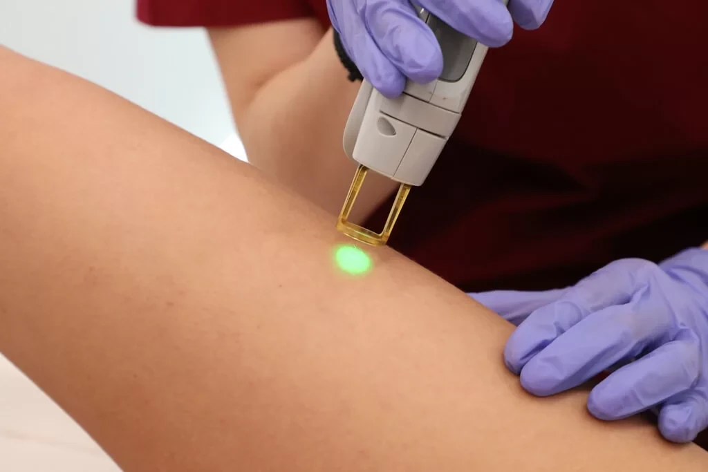Laser αποτρίχωση στο πόδι